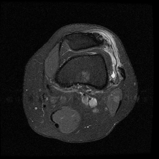 Figure 3 for case Lateral patellar retinaculum tear